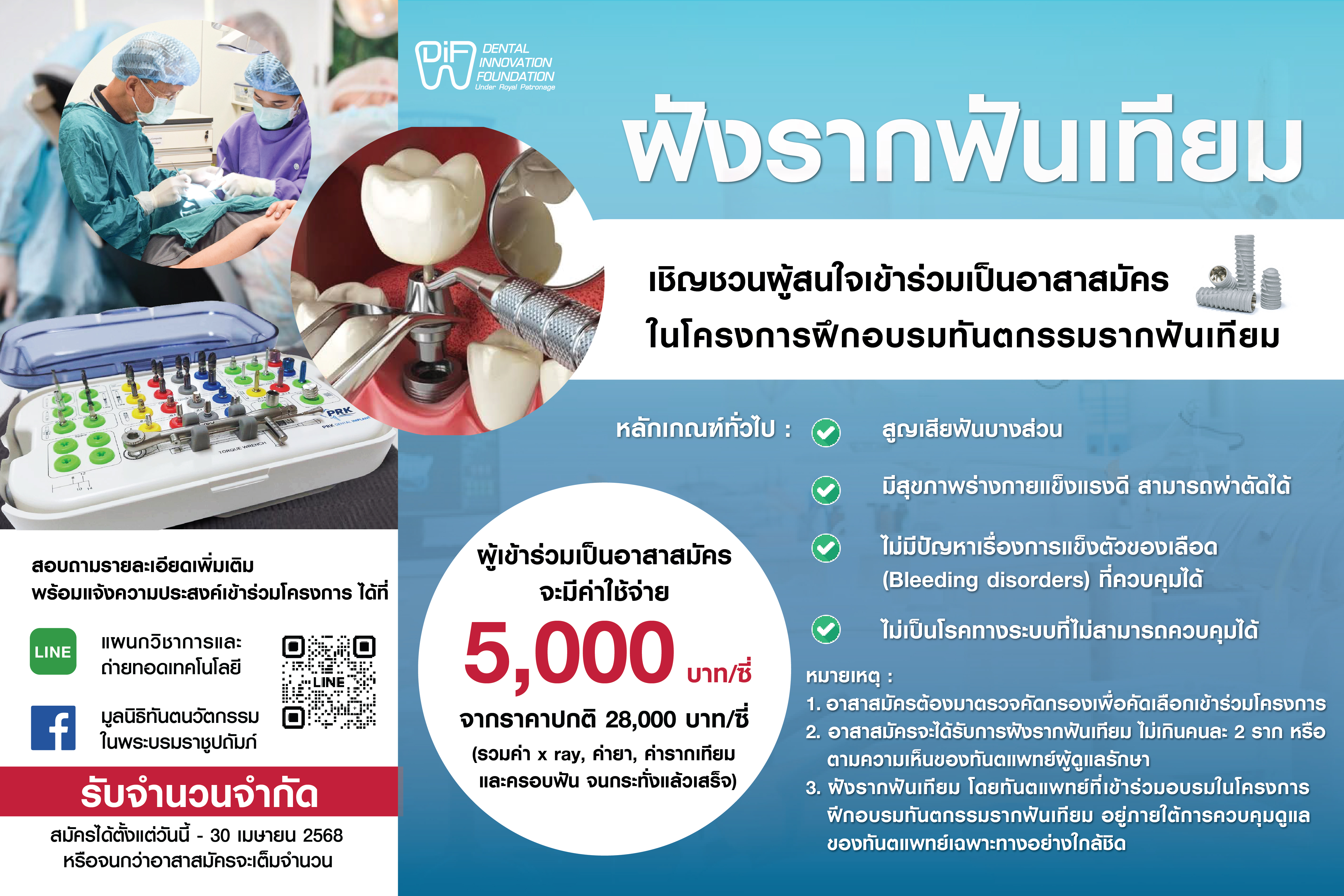 ขอเชิญชวนผู้ที่สนใจเข้าร่วมเป็นอาสาสมัคร "ฝังรากฟันเทียม" ในโครงการฝึกอบรมทันตกรรมรากฟันเทียม